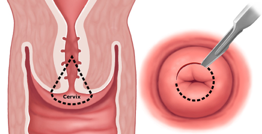 последствия конизации шейки матки