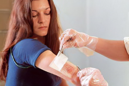 Лечение термических ожогов Лечение термических ожогов