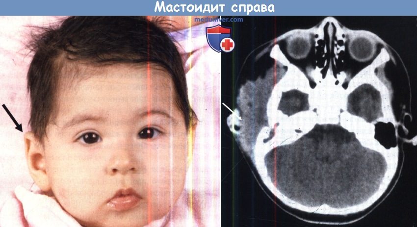 Осложнение среднего отита среднего уха Осложнение среднего отита среднего уха thumbnail