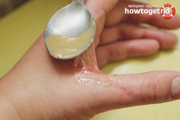 Народные средства против ожогов