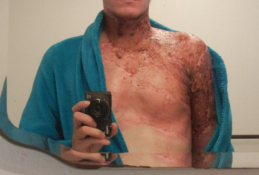 Мужчина с ожогами грудной клетки