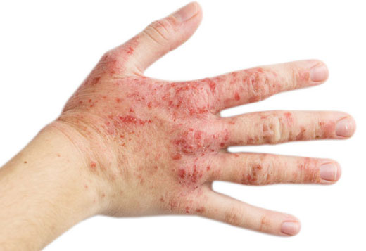 Ожог от перекиси на руке