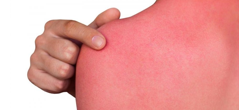 Ожог Как лечить ожог от лучевой терапии