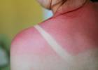 Ожог 1 степени Ожог 1 степени
