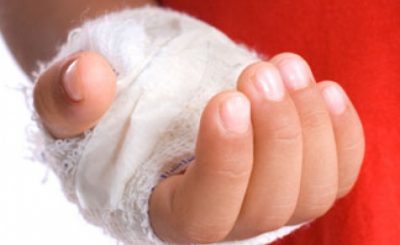 Чем намазать ожог если лопнул пузырь