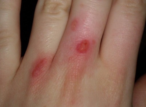 Ожог от Веррукацида на пальцах Ожог от Веррукацида на пальцах