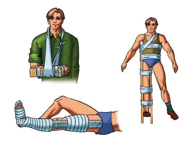 Первая помощь при ушибах вывихах ожогов переломов