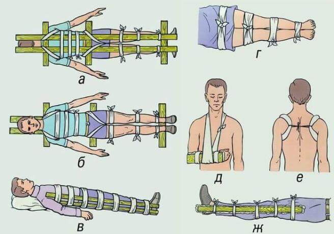 Первая помощь при ушибах вывихах ожогов переломов