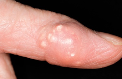 Подагрический тофус с кристаллами мочевой кислоты Подагрический тофус с кристаллами мочевой кислоты