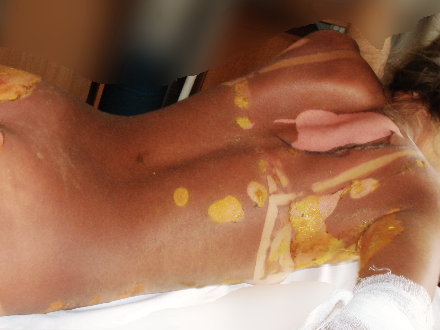 Солнечный ожог 2–3 степени