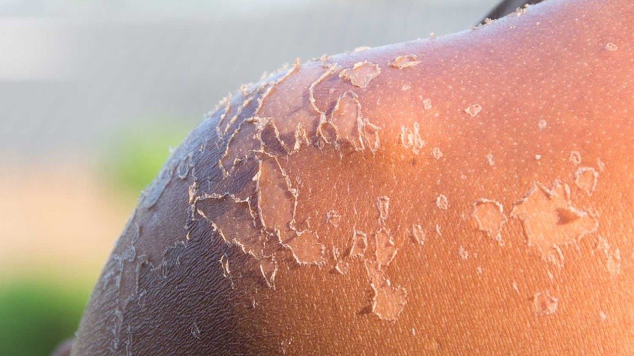 Облезающая после загара кожа