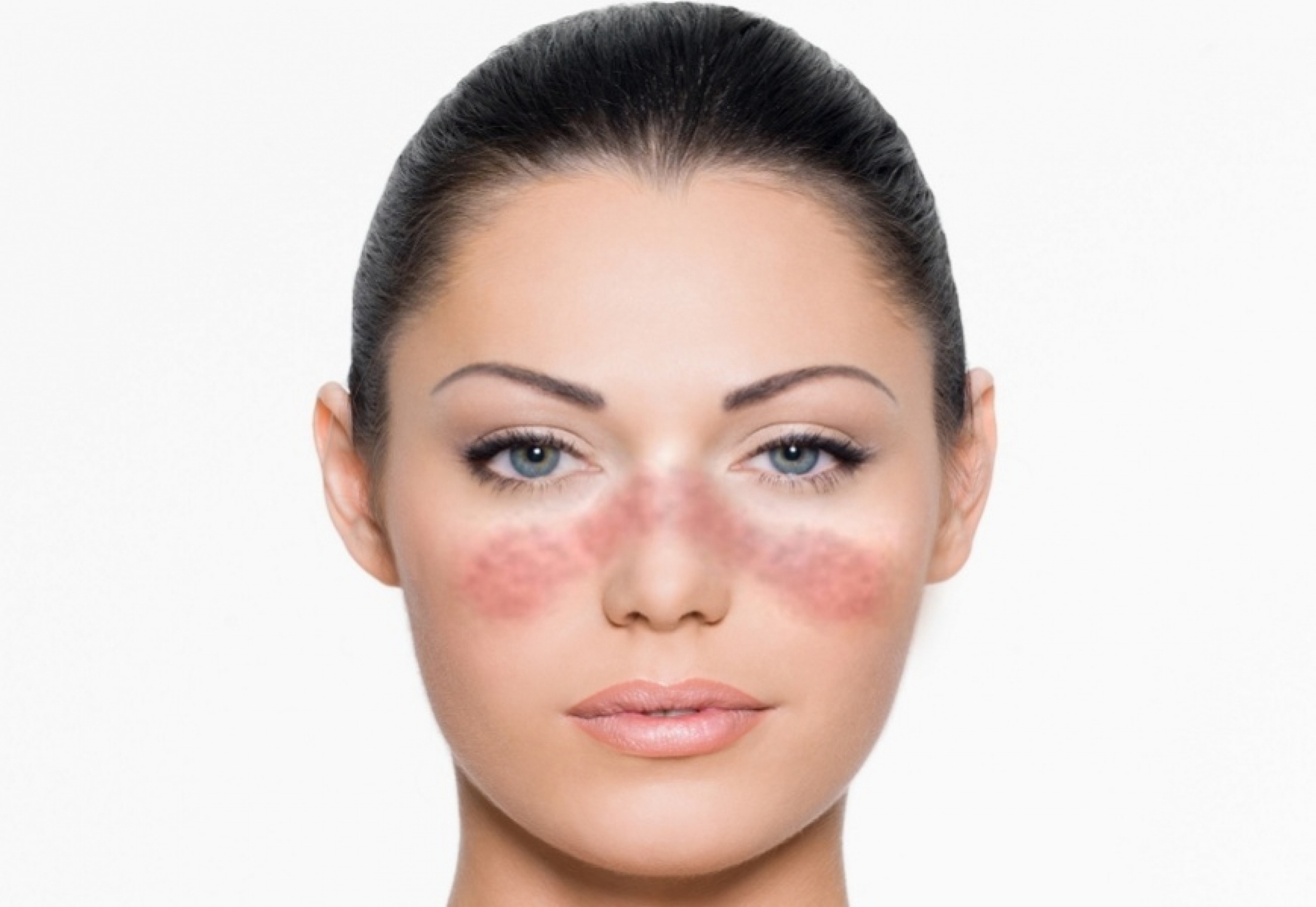 Волчанка на лице