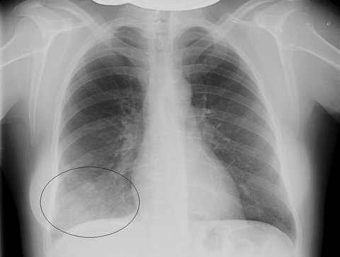 Рентгенограмма лёгких при сегментарной пневмонии Рентгенограмма лёгких при сегментарной пневмонии