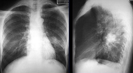 Рентгенограмма при очаговой пневмонии Рентгенограмма при очаговой пневмонии