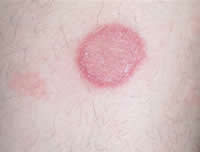 Болячка на теле Лечение пятна на коже в виде ожога