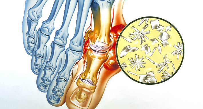 Как в домашних условиях можно вылечить подагру
