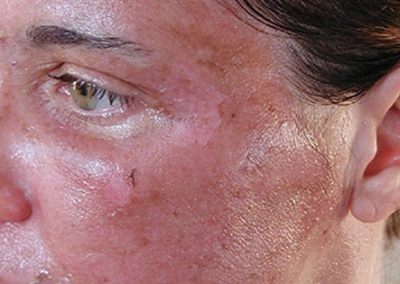 Ожог на лице после салициловой кислоты Ожог на лице после салициловой кислоты