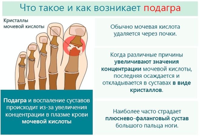 Подагра ног и жжение стопы