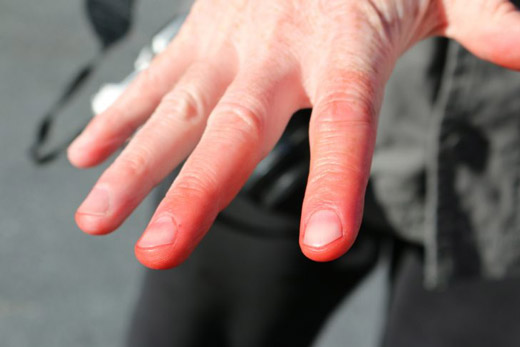 обмороженные руки