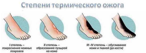степени ожогов