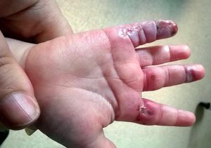 Чем облегчить боль от ожога утюгом