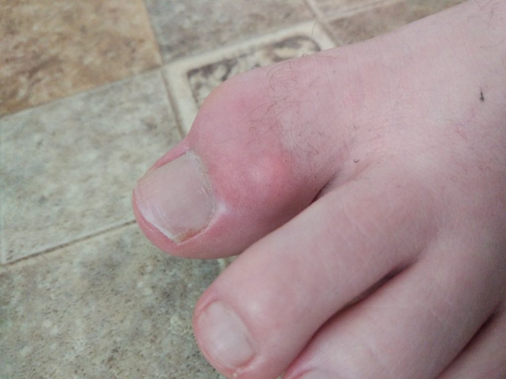 Удаление подагры на ногах лазером Удаление подагры на ногах лазером thumbnail