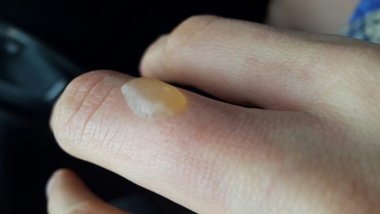 Что делать если содрали волдырь от ожога