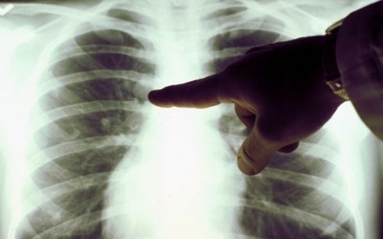 Затемнение на флюорографии после пневмонии Затемнение на флюорографии после пневмонии thumbnail