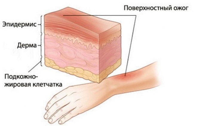 Глубина поражения тканей при ожогах Глубина поражения тканей при ожогах
