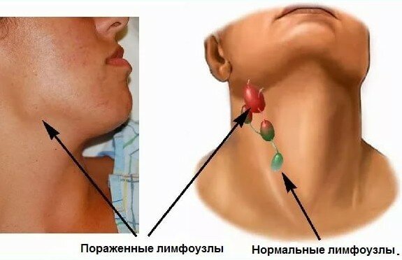 Болит лимфоузел на шее справа отдает в голову