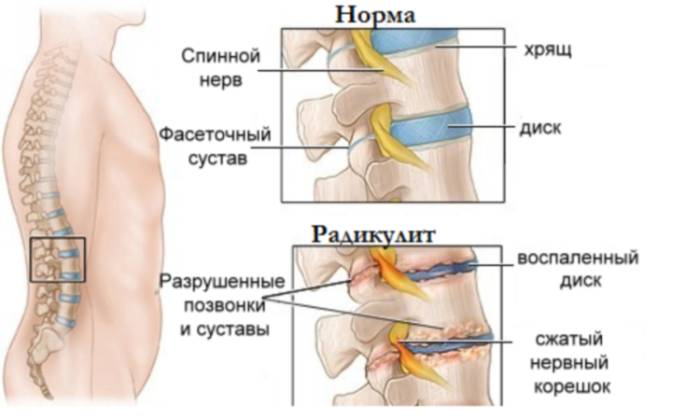 Если болит спина тренажер