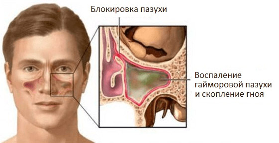 Если болит голова и сопли с кровью