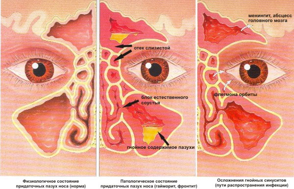 Если болит голова и сопли с кровью