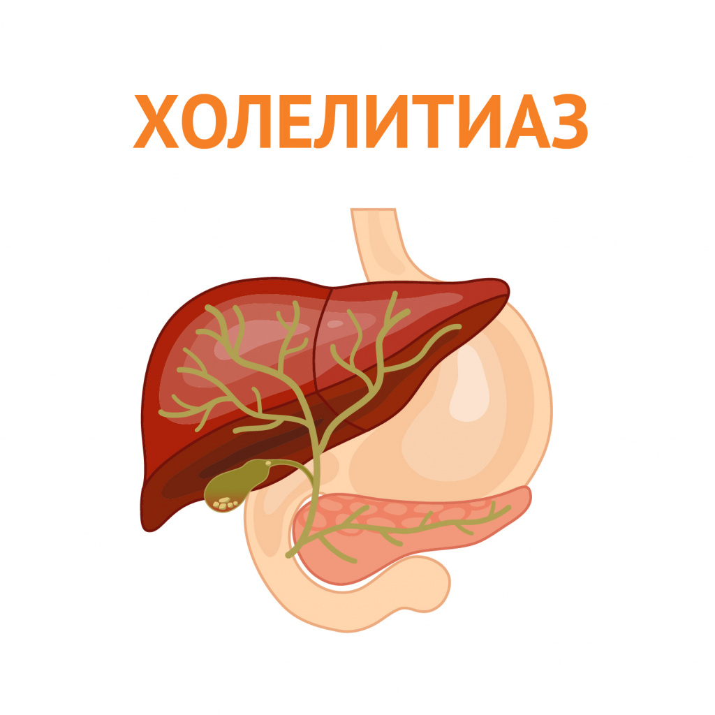 желчнокаменная болезнь.jpg желчнокаменная болезнь.jpg
