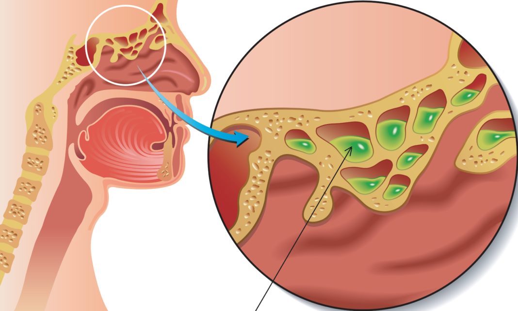 Этмоидит Воспаление слизистой оболочки кости