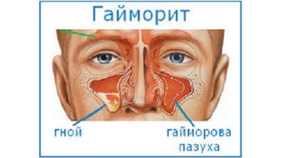 Болит спина пах температура