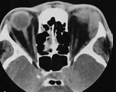 Болит шея голова насморк